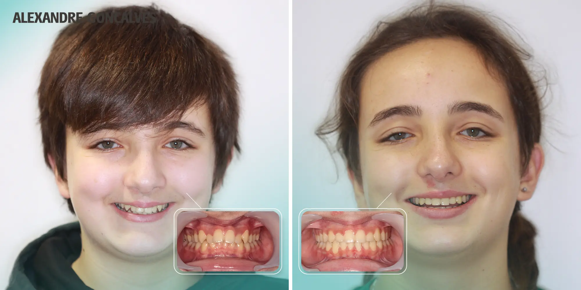 Ortodontia Invisível Ortodontia Clássica Invisalign Spark Alinhadores Alinhadores Invisíveis Aparelho Transparente Aparelho Metal