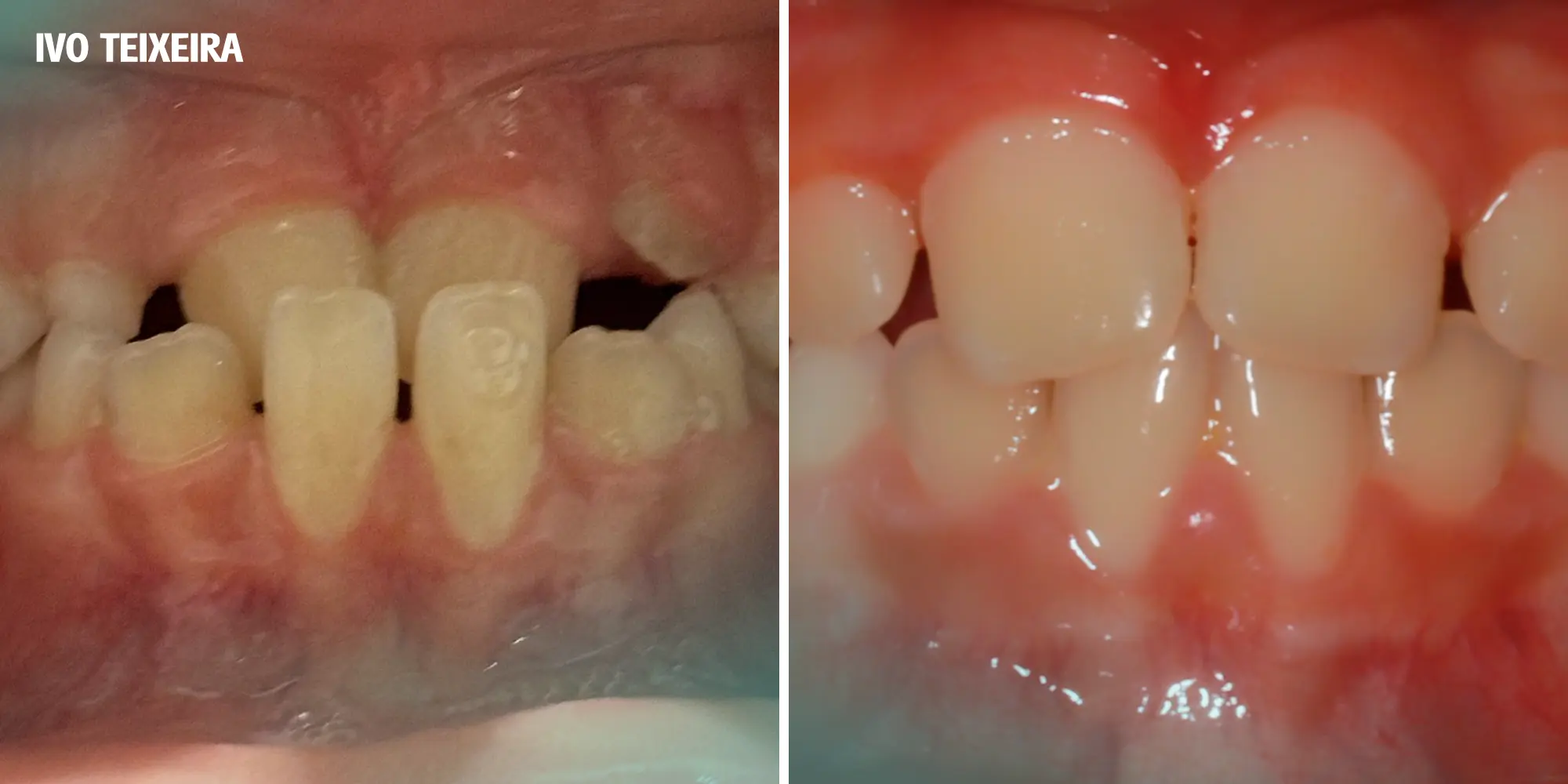Ortodontia Invisível Ortodontia Clássica Invisalign Spark Alinhadores Alinhadores Invisíveis Aparelho Transparente Aparelho Metal