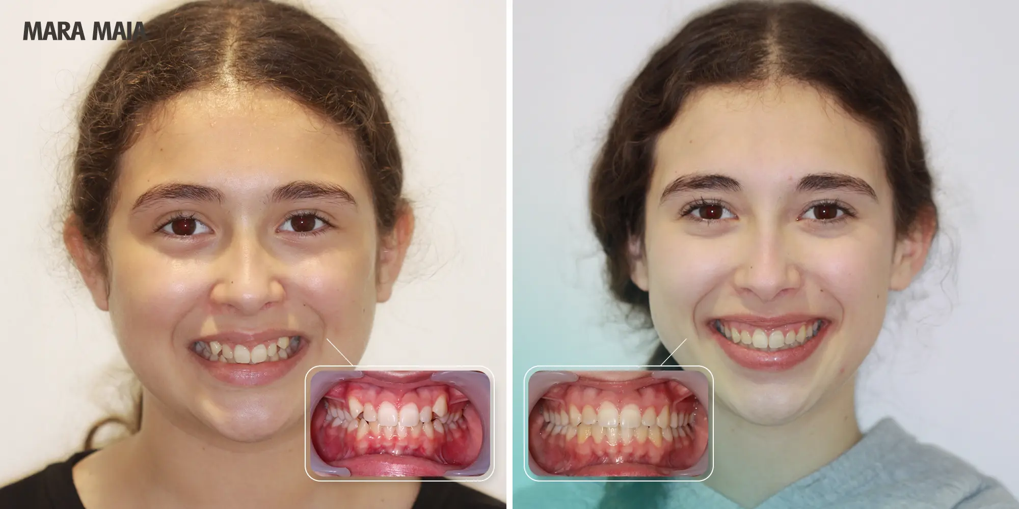 Ortodontia Invisível Ortodontia Clássica Invisalign Spark Alinhadores Alinhadores Invisíveis Aparelho Transparente Aparelho Metal