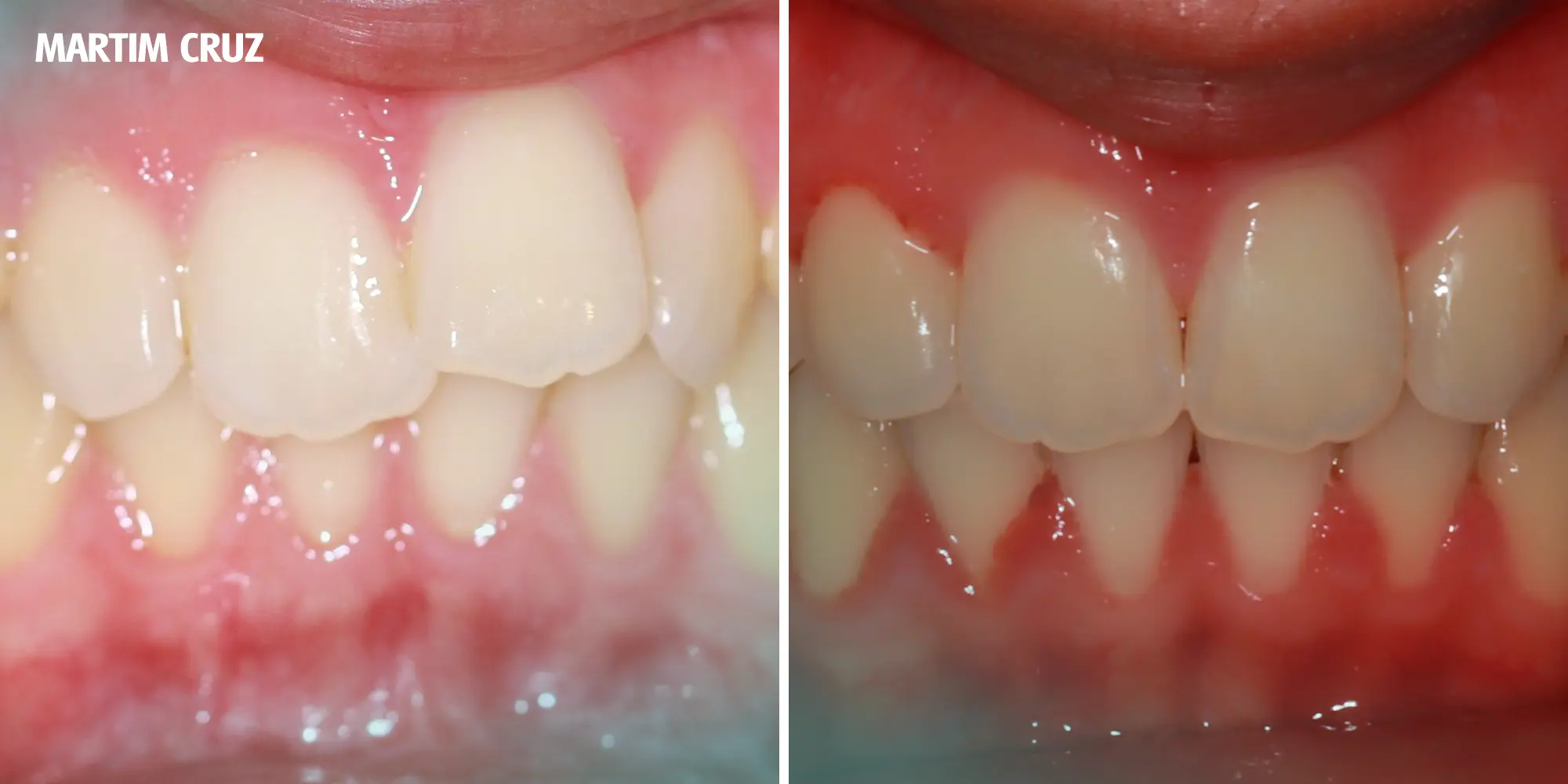 Ortodontia Invisível Ortodontia Clássica Invisalign Spark Alinhadores Alinhadores Invisíveis Aparelho Transparente Aparelho Metal